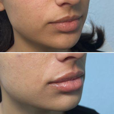 Minimal amount of HA filler was added to enhance the lateral parts of the patient's lips while maintaining her natural full lips.