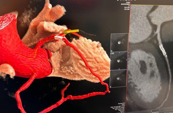 Advanced imaging can define stents.