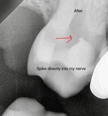 This new X-ray shows painful filling that is infected & needs a root canal, I had absolutely no pain from this tooth prior to the filling.