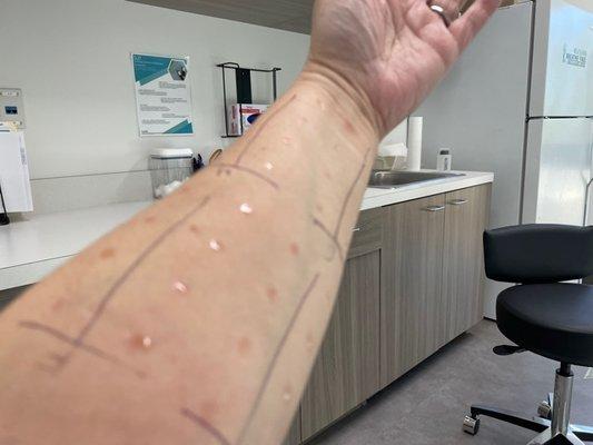 allergy testing on arms.