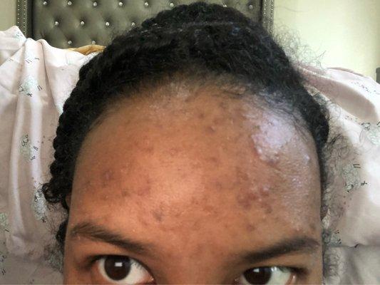 BEFORE. Forehead and nose always the main issue. Hyperpigmentation & acne