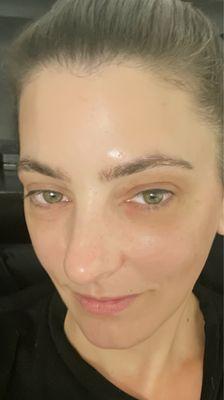 1 month after under eye PRP treatment