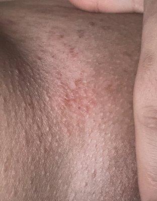 Burned from wax  on vagina