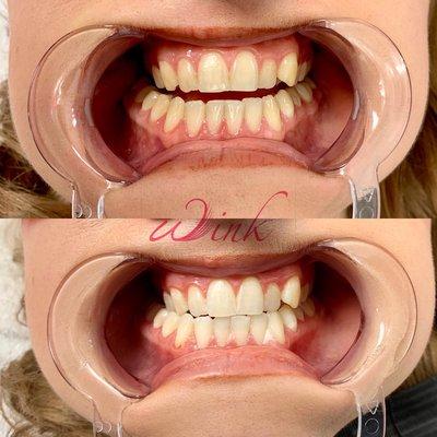 Teeth whitening