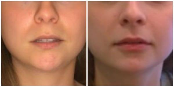 Lips - Before/After