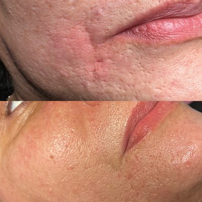 Nasal labial filler 1 session (hyaluronic acid)