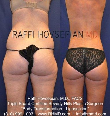 Advanced Body Contouring by Dr. Raffi Hovsepian. (310) 999-1003 www.RHMD.com