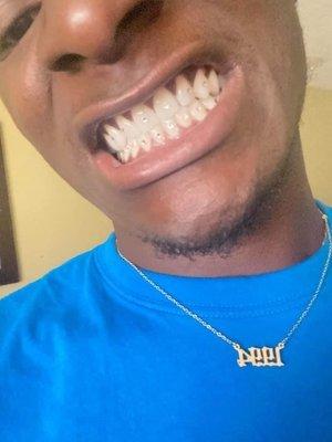 Teeth bling