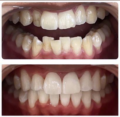 6 month of clear aligners @ serene smiles