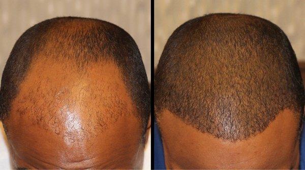 49 year old African American Male FUE: 2,432 grafts 12 month results