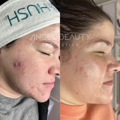 Acne Program and Acne Scarring