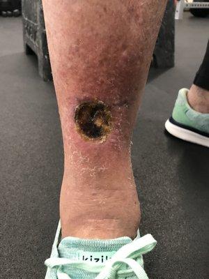 radiation necrosis as finally diagnosed May 15 by Wound Center