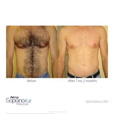 Chest laser hair removal by Soprano ICE platinum