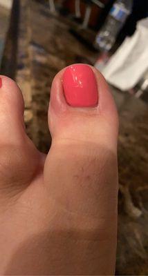 Infected nail