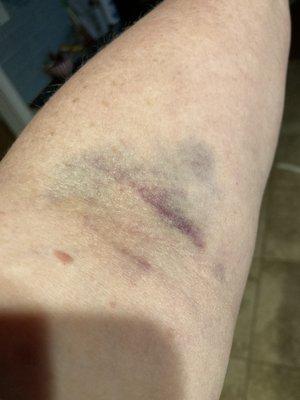 My arm 24 hrs after blood work ... this is a first and hurts.