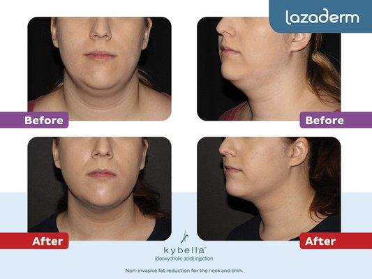 Kybella Before and After