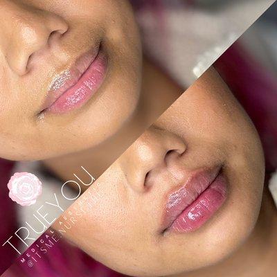 Lip Filler by Nurse Thu