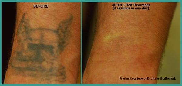 Forearm Tattoo Removal Before & After after 4 Treatments in 1 day