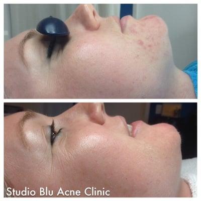 Before/After Studio Blu Acne Clinic