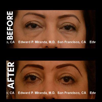 Before & After BLEPHAROPLASTY (Eyelid Surgery, Eye Lift). Remove excess skin from the upper eyelids, reduce bagginess from lower eyelids.