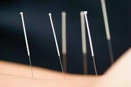 San Francisco's Best Acupuncture and Cupping!