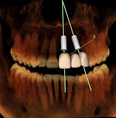 We virtually plan our dental implant procedures to ensure a more precise and efficient process for our patients.