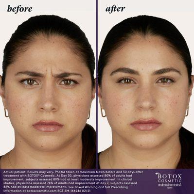 Botox-Before and after