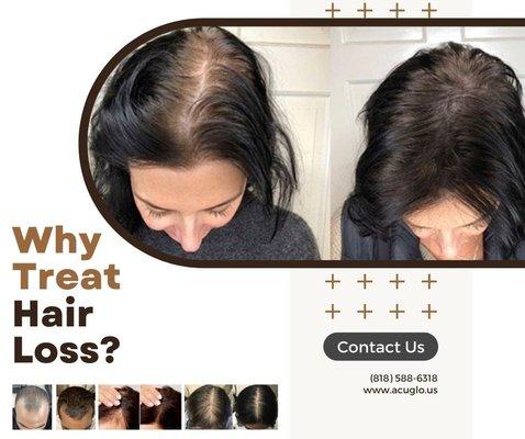 A great representation of before and after in terms of treating hair loss with microneedling, acupuncture and light therapy.