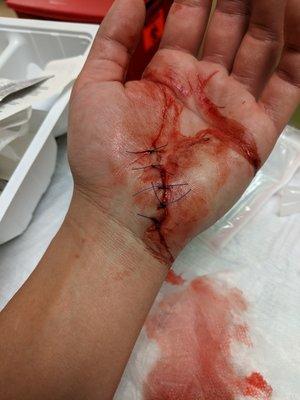 My hand after the Doctor told Nurse Rama to clean my hand before dressing it. Good cleaning job Rama!