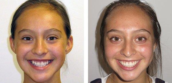 Amazing Smile Transformation - Before and After Results. We Offer Invisalign, Damon Braces, Ceramic, Metal, Lingual Braces - Youth & Adults.