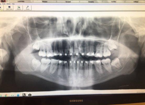 Xray of my teeth at 2nd opinion