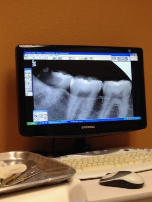 Molar #17 is severely decayed. I came in with an upper molar problem. Dr. Nguyen tested the upper molar and suspected it was a lower molar.