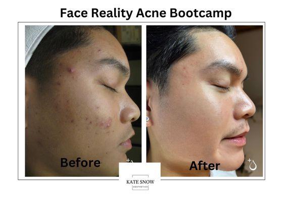 Face Reality Acne Bootcamp