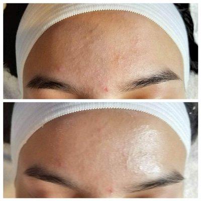 Before and after of Acne Signature Facial