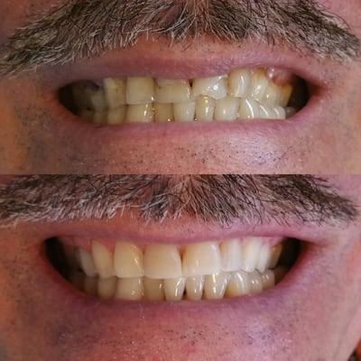 This is an actual patient of ours, composite veneers were placed on 9 of his teeth. It's amazing how the smile changes with confidence!