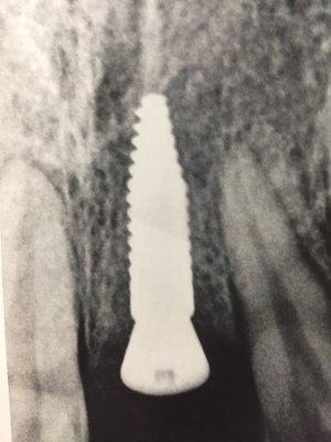 X-ray of my Dental Implant