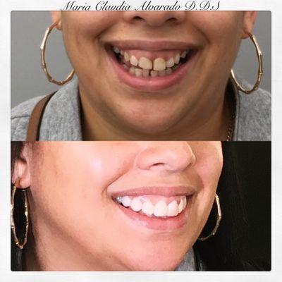 Aesthetic dental work. Example of Dr. Alvarado's work.