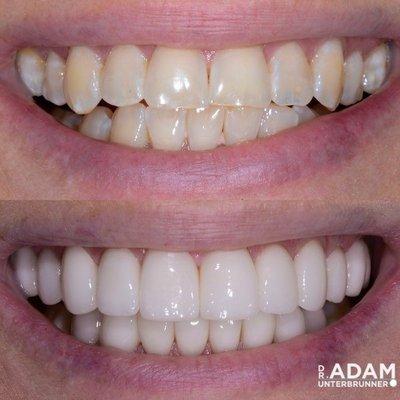 This patient wanted a new smile with whiter teeth.  Another great result from Dr. Adam Unterbrunner