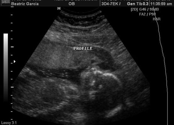 Baby Roman at 20 weeks