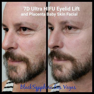 Non surgical 7D Ultra Max Eye Bag reduction