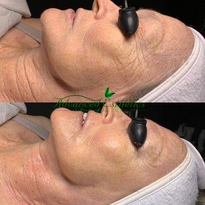 AntiAging Facial