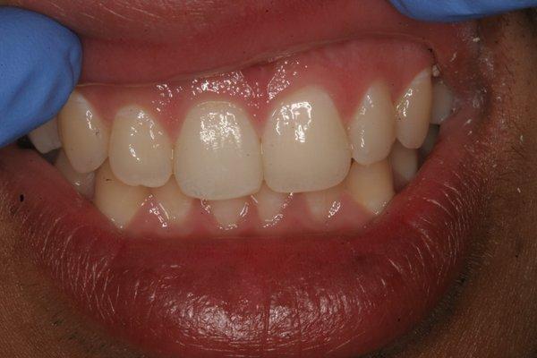 Conservative treatment for a discolored tooth.  After photo.