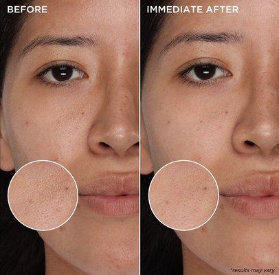 Results after 1 use! Get pores that feel deeply purified and skin that clears over time!