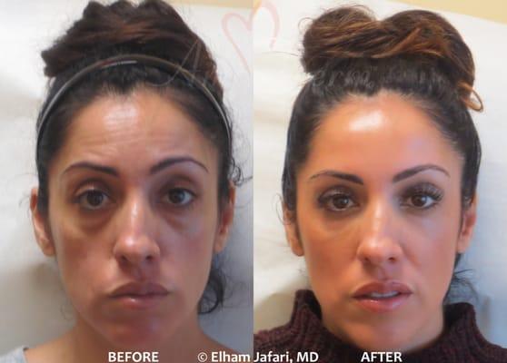 Liquid Facelift with combination of Botox, Dysport, at forehead & filler injected  under the eyes, cheeks, (Voluma, Volbella, Restylane )