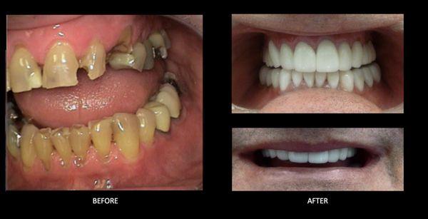 Full mouth reconstruction case with crowns and one implant crown for missing space on upper.