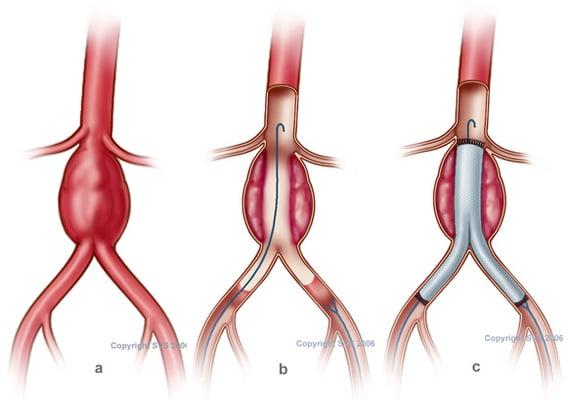 Incisionless Treatment of Abdominal aortic Aneurysm