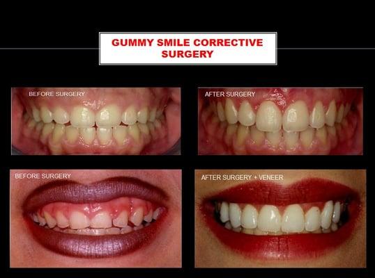 CASE 9701 & 860: Gummy smile