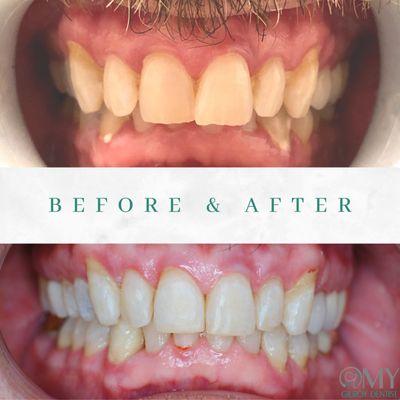 Completed Invisalign case - straightened teeth, corrected deep bite, improved midline!