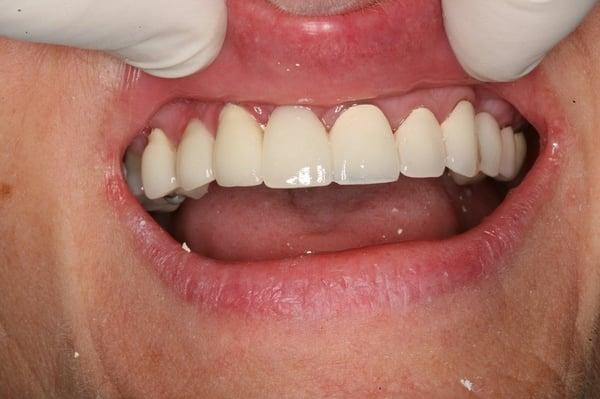 After: Cosmetic Anterior Bridge