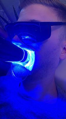 LED light activated teeth whitening.